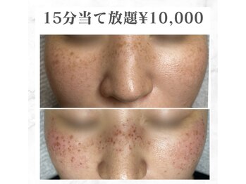 美人/シミケア15分