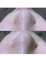 ナチュウル(Natulu)/ハイドラ毛穴洗浄