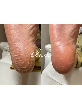 角質ケアができるサロン