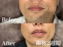 ボス 岡崎店(BOSS)/【顔脱毛/ヒゲ脱毛】口下　#脱毛