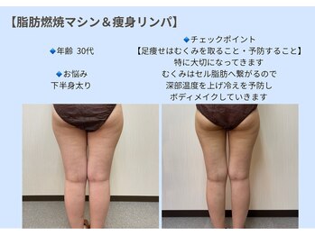 ビオルブ(VIOLVE)/痩身/ダイエット/むくみ改善