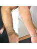 イオン導入美肌脱毛で毛穴も目立たない綺麗な腕へ！【腕脱毛】