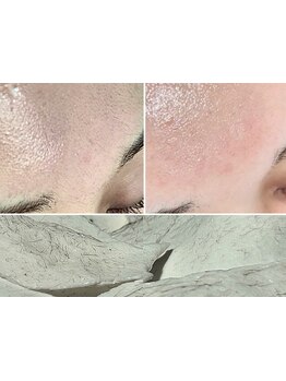 顔脱毛がしたい