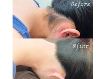 ララリア(LaLaLia)/うなじWAX脱毛