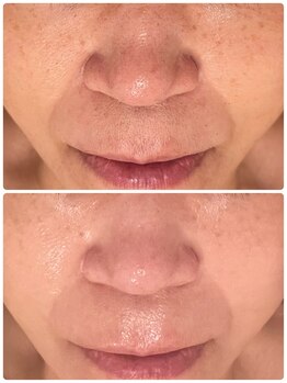 シェノン(Chainon)の写真/口コミ高評価◎ララピールの進化版セラピールで、ひらき毛穴・たるみ毛穴・黒ずみ毛穴すべてアプローチ!