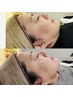 【別人級ケア】テラボーラー×レッドショットで最高級の小顔へ