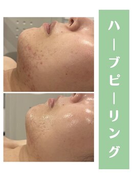 心斎橋 ルヴィ(REVI)/ハーブピーリングの変化