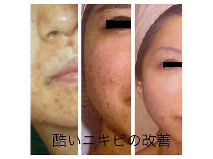 トータルエステ ユキ(YUKI)の写真