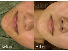 レイ(Lei)/しぶとい顎周りニキビにも◎