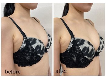 ルミエール(Lumiere)/【倉敷市】バストアップ施術事例