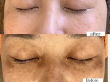 ステラルーテ(Stella lute)/ハーブピーリング