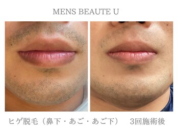 ユー(U)/ヒゲ脱毛