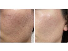 ノイ(Noi)/プラズマシャワー