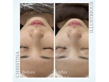 シャルムパリス(charme paris)/シミを作らない◎１回の施術変化