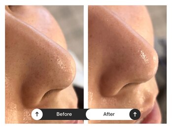 リジュ(Reje)/毛穴洗浄によるケア