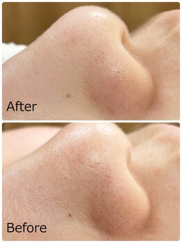 ハクミー(haku me)/☆鼻毛穴の汚れ黒ずみの変化☆