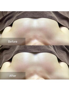 ノルン(Norn)/30代育乳バストケア（6回目）