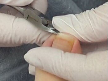 コモドキュア 札幌店の写真/【医療機関と提携】長年の巻き爪やボコボコ爪など…足爪のお悩みお任せください◎特許取得器具で根本ケア！