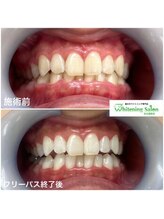 ホワイトニングサロン 名古屋駅店/【ホワイトニング施術例】