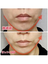 トータルビューティーサロン デザイン/光フェイシャル2回モニター