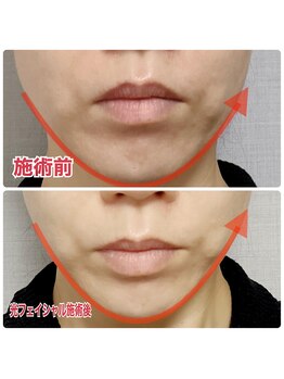 トータルビューティーサロン デザイン/光フェイシャル2回モニター