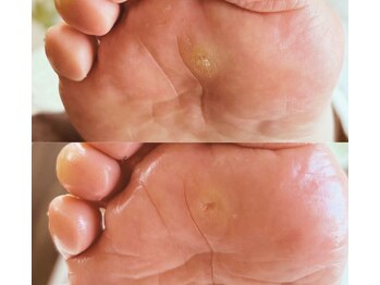 アベビー(Abeby)/ウオノメ