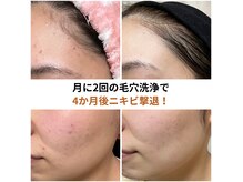 ビーボヌール(be-bonheur)の雰囲気（ニキビケア/約半年間の肌に優しい毛穴洗浄脱毛効果もアップ）