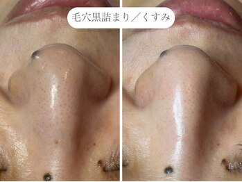 フラックス 京都(FLUX)/【エンビロン】黒詰毛穴コース