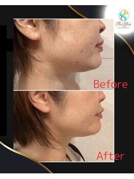 フォーユー 飯能店(Foryou)/レモンボトル1回