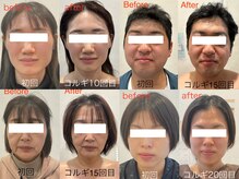 それぞれのお悩みを改善し、美しい小顔に導きます☆