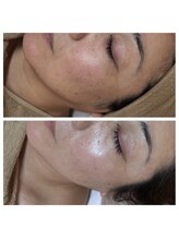 クリア 栄生(CLEAR)/ピーリングで肌で明るく