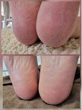 エーケーネイル(AKnail)/かかとケア付きフットジェル