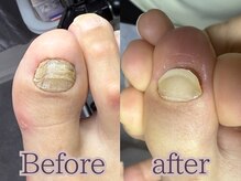 ポドロ(PoDoLo)/【肥厚爪・分厚い爪】