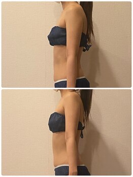 うつくし痩身 美サロン ゼットワン(Z-ONE)/メディセル１回　before　after