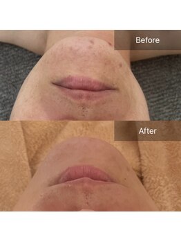 サロンツキ(salon tuki)/【ハーブピーリング】症例★