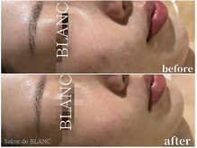 サロン ド ブラン アオヤマ(Salon de BLANC AOYAMA)/クリスティーナハーブピーリング