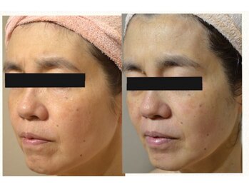 インナーメス(INNER MES)/磁石の力で明るい印象へ!