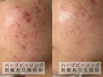 育肌美研 自由が丘サロン/ニキビケア|ハーブピーリング