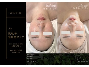 オーヴォ リビングスパ アネックス マノン(OVO LIVING SPA annex MANON)/【施術事例】肌改善短期集中ケア