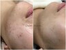 【人気NO.1！】ヒト幹細胞ベーシックコース★敏感肌◎ニキビケア◎