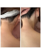 イヴ(Yves)/うなじbefore/after