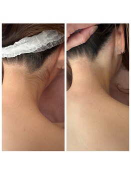 イヴ(Yves)/うなじbefore/after