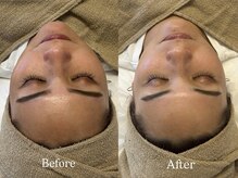 トム(Thom)/くすみ悩みにはハーブピーリング