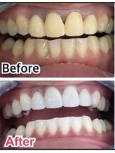 ホワイトニングスタイル 柏店/差し歯、銀歯があっても大丈夫