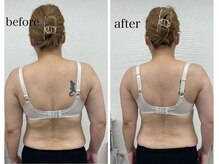 ルミエール(Lumiere)/【倉敷市】バストアップ施術事例