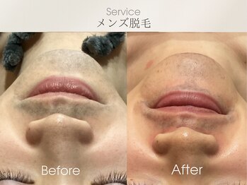 フェイシャルサロン ベルダ(BELDA)/【メンズ髭脱毛】