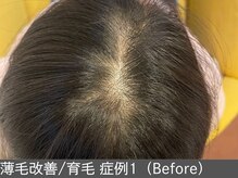 オアシスラグーン(OASIS LAGOON)/育毛促進（症例1 before）