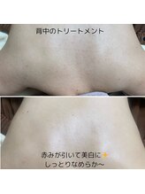 フォーユー マシバメディカル(For You Mashiba Medical)/背中のトリートメント