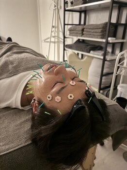 ラフテル鍼灸整骨院/メンズにも人気の美容鍼♪