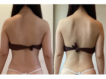 ビューティーマックス(Beauty Max)/痩身　before→after 3ヶ月後